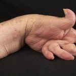 лечение артрита рук