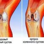 артроз коленного сустава 