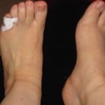 Изображение - Повреждение сустава пальца ноги 0-2-150x150