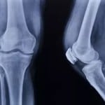 деформирующего артроза колена