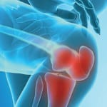 Лечение артроза артрита коленного сустава
