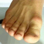 шишки на суставах пальцев ног
