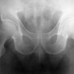 рентген тазобедренного сустава