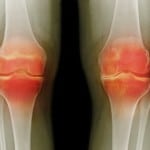 Подагрический артрит коленного сустава симптомы и лечение