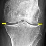 Пирофосфатная артропатия коленного сстава
