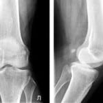 Остеоартроз коленного сустава 1 степени