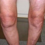 Остеоартроз коленного сустава 1 степени