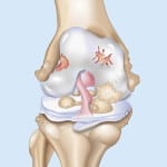 Из за чего возникает артроз коленного сустава thumbnail