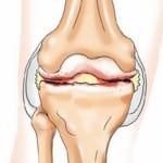 Изображение - Причины развития артроза коленного сустава 1-399-150x150