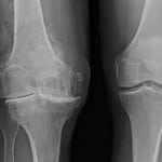 Изображение - Артроз 4 степени коленного сустава как вылечить 1-419-150x150