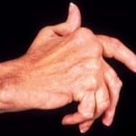 остеопороз кистей рук