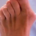 Артрит пальцев ног симптомы и лечение