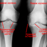 Изображение - Причины развития артроза коленного сустава 1-7-150x150