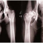 Изображение - Дисплазия т б суставов рентген снимки 1-763-150x150