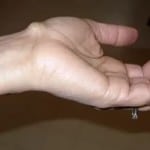 Изображение - Киста сустава кисти руки лечение 1-821-150x150