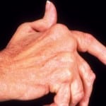 Ревматоидный артрит как может появиться thumbnail