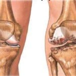 Артроз коленного сустава