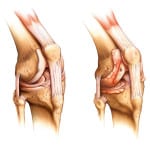 ревматоидный артрит коленного сустава