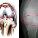 Деформирующий артроз коленного сустава лечение 2 степени