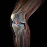 возникновение боли в колене