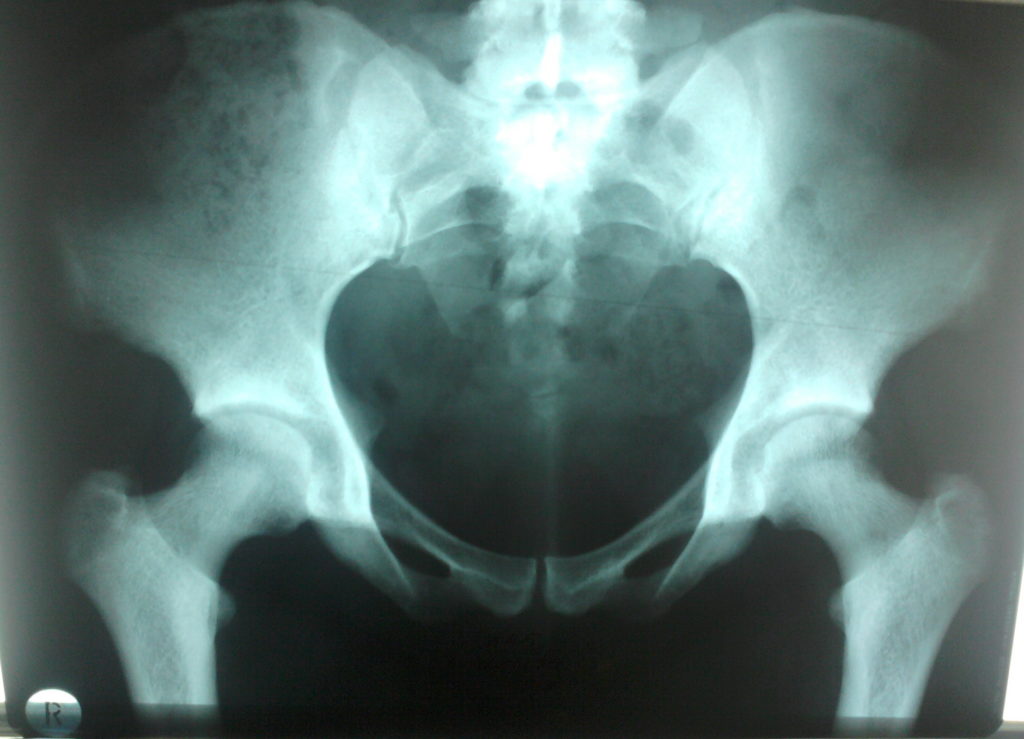 Дисплазия тазобедренных суставов рентген углы 122