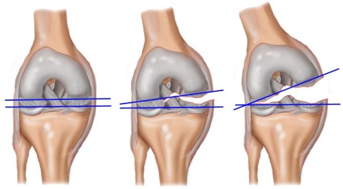 Почему возникает боль сзади колена