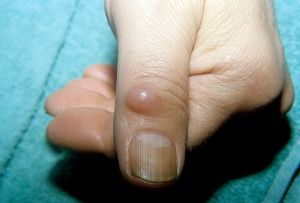 Шишки на суставах пальцев рук причины и лечение