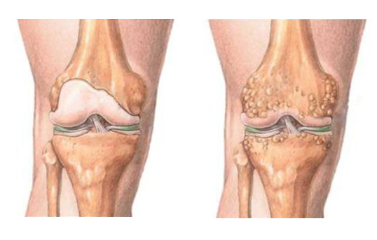 Почему болит колено сбоку с внутренней и внешней стороны