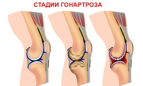 Тренажеры при артрозе коленных суставов