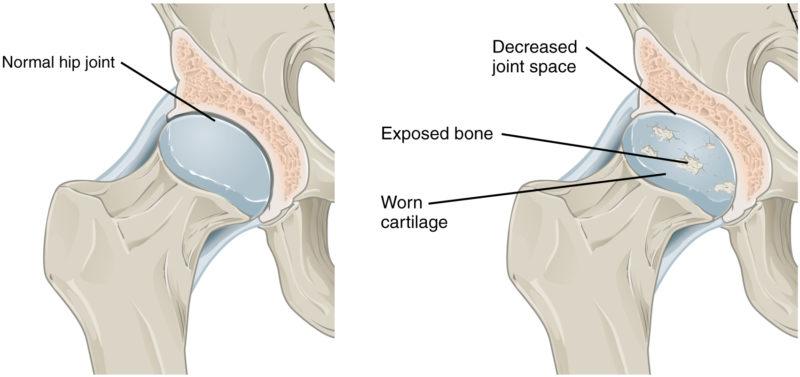 Сужение суставных щелей лечение сужения суставной щели коленного сустава, размер суставной щели в норме, неравномерно сужена
