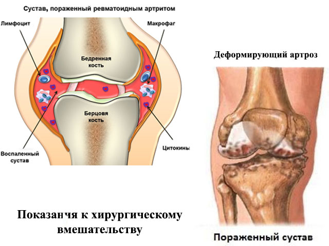 Ревизионное эндопротезирование коленного сустава