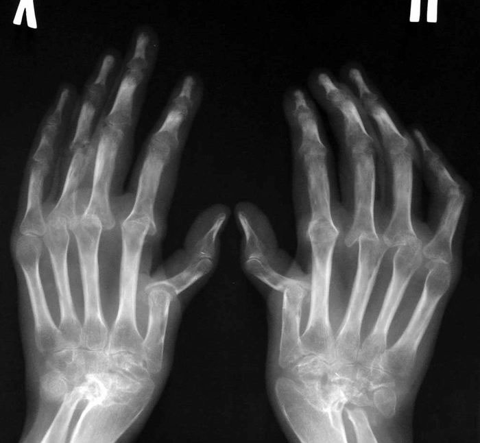 Первые симптомы ревматоидного артрита пальцев рук фото, лечение