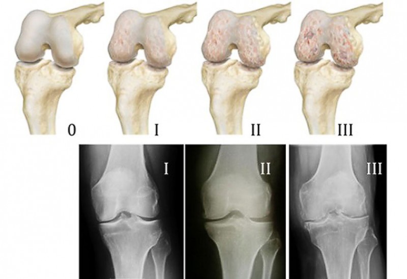 Дегенеративно дистрофические изменения коленного сустава