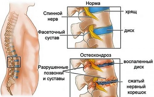 Симптомы и признаки остеохондроза шейного отдела позвоночника