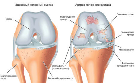 Парафинотерапия для суставов ног