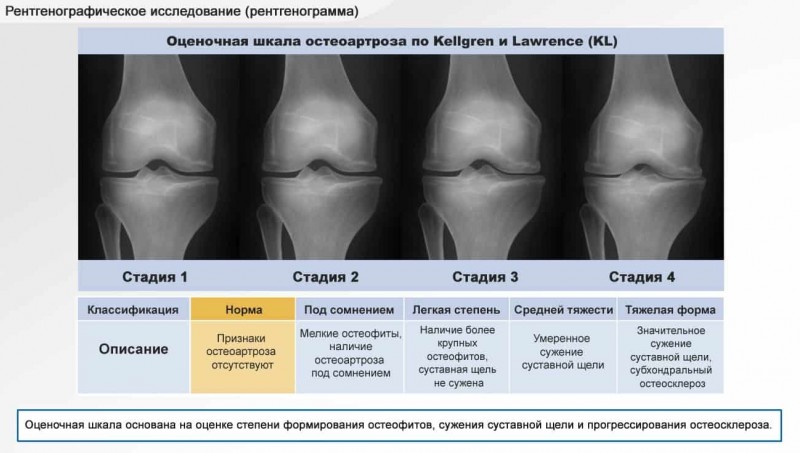 Диагностика коленного сустава. Острый гнойный артрит