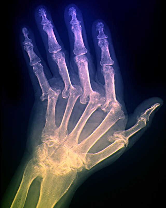 К какому врачу обращаться при болях в суставах пальцев рук и наростах