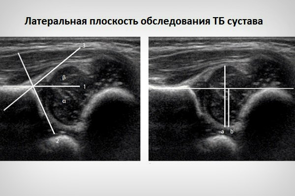 Что показывает КТ тазобедренного сустава и пояснично-крестцового отдела позвоночника