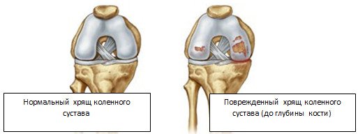 Методы восстановления хрящевой ткани после травм коленного сустава
