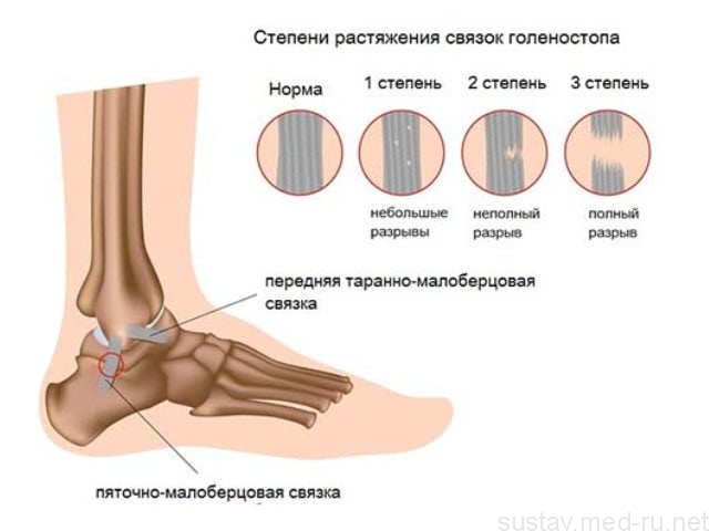 Травмы коленного сустава