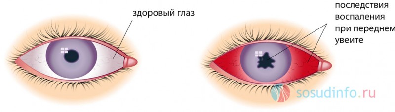 Увеит воспаление сосудистой оболочки глаза причины, формы, признаки, лечение