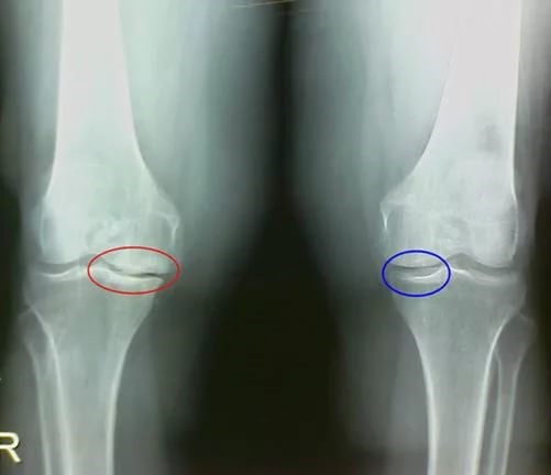Методы восстановления хрящевой ткани после травм коленного сустава