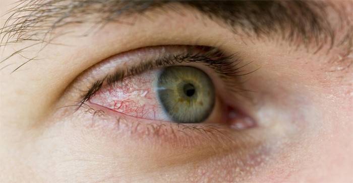 Увеит воспаление сосудистой оболочки глаза причины, формы, признаки, лечение