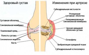 Лечение артроза суставов