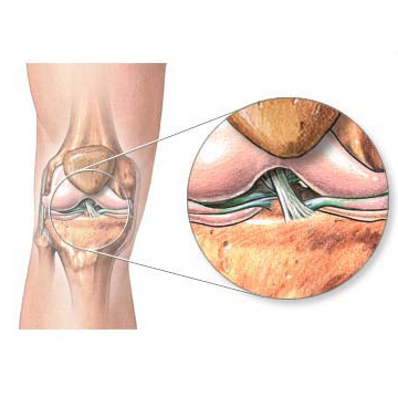 Симптомы и  эффективное лечение воспаления связок коленного сустава лигаментит и лигаментоз