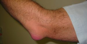 Подагра симптомы, фото с изображением деформированных суставов