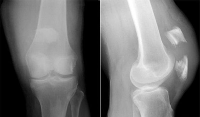 Симптомы и лечение перелома коленного сустава