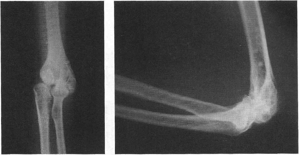 Диагноз локтевого сустава. Остеоартроз локтевого сустава рентген. Деформирующий артроз локтевого сустава. Деформирующий артроз локтевого сустава рентген. Эпикондилит локтевого сустава рентген.