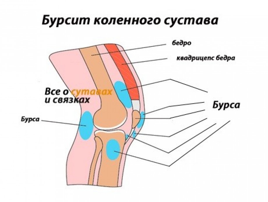 Народные методы лечения бурсита коленного сустава в домашних условиях