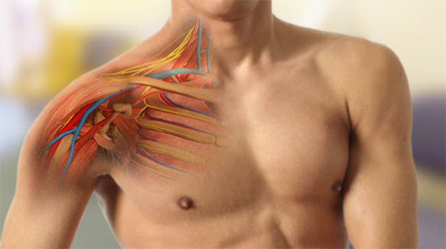 Проявления и терапия нейропатии плечевого сплетения